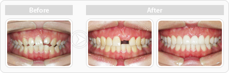 치아가 없는 경우 교정 치료사례
